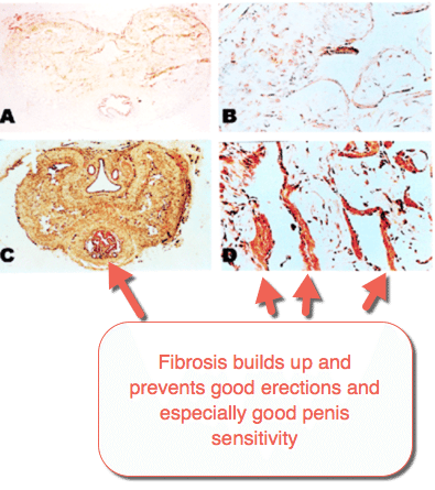 Fibrosis builds up and prevents good erections and especially good penis sensitivity