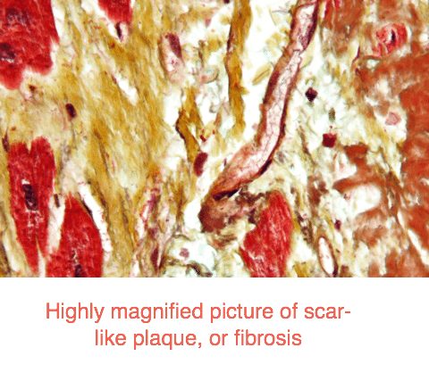 Highly magnified picture of scar-like plaque, or fibrosis