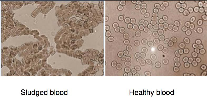 Do you suffer from intravascular agglutination?