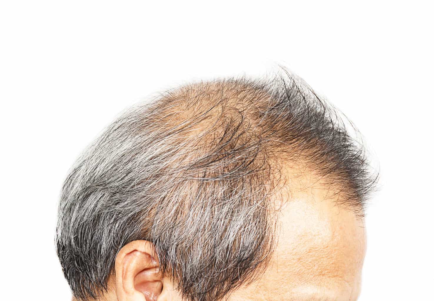 Приснилось выпал волос на голове. Стрижки при облысении. Длинная стрижка мужская пожилой облысение. Дигидротестостерон и волосы на голове. К чему снится выпадение волос на голове.