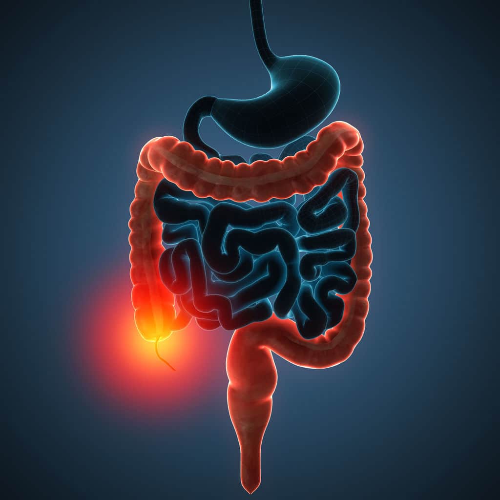 Natural treatment for ulcerative colitis Natural treatment for ulcerative colitis