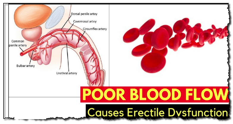 Poor Blood Flow causes Erectile Dysfunction