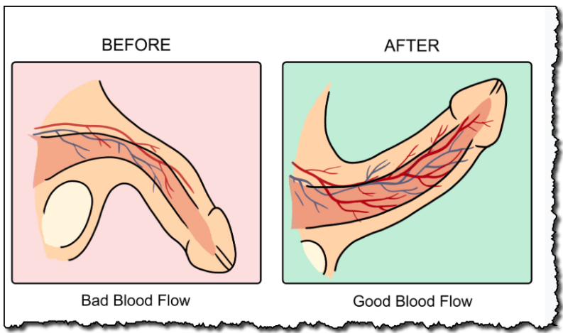 Bad Blood flow and Good Blood flow