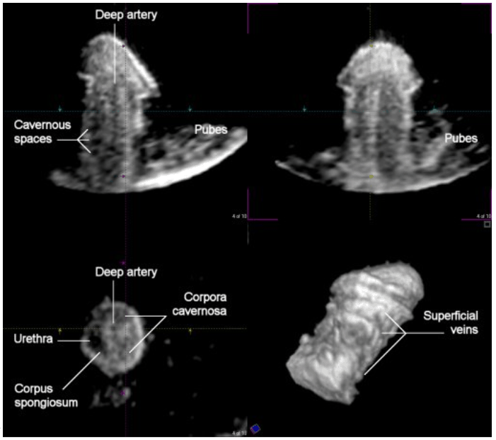 Daily Medical Discoveries Image - Penile Blood flow