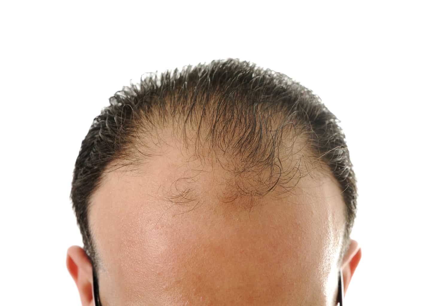 Male pattern baldness explained - 2017.