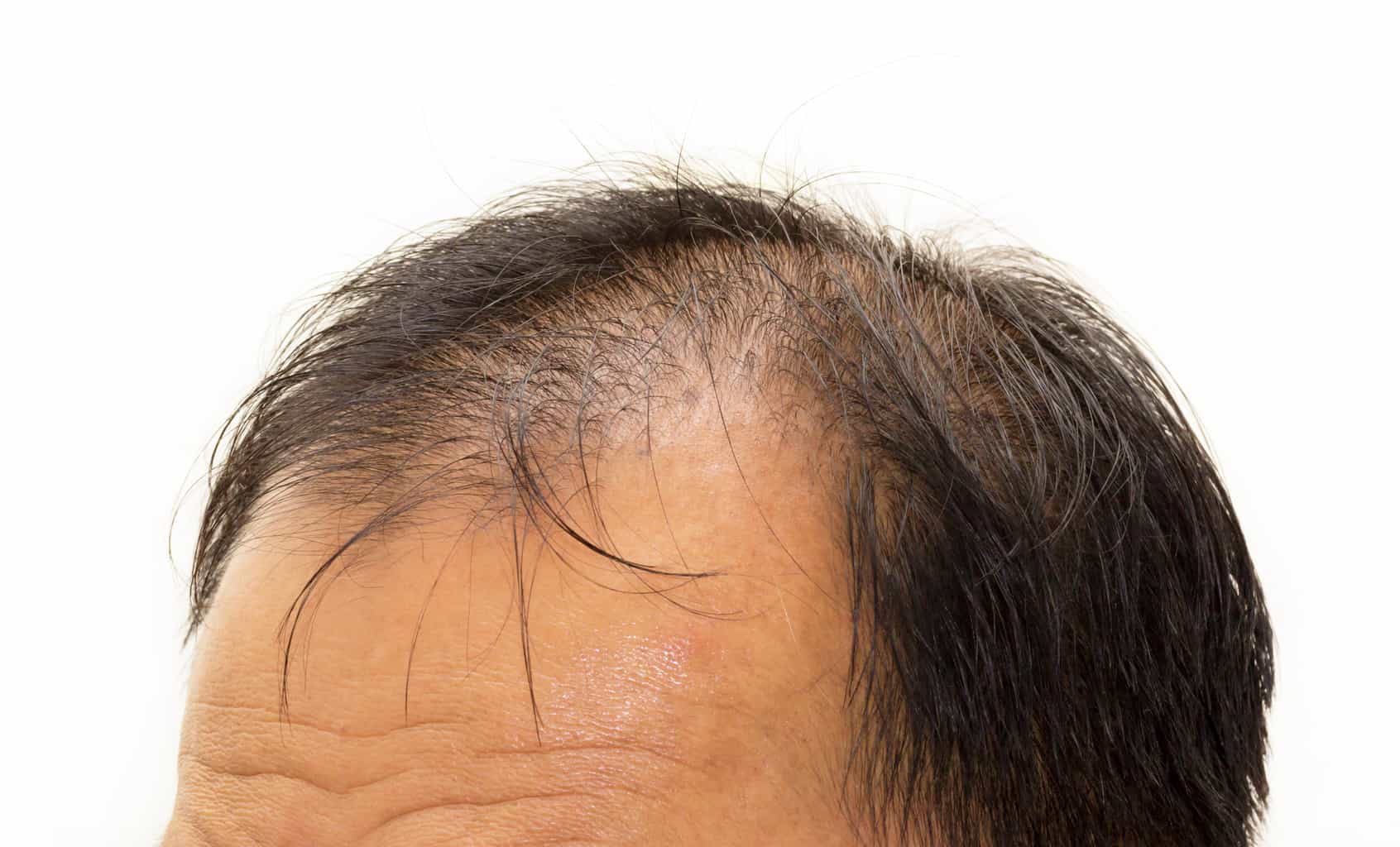 Vitamin D and hair growth: More important than you thought