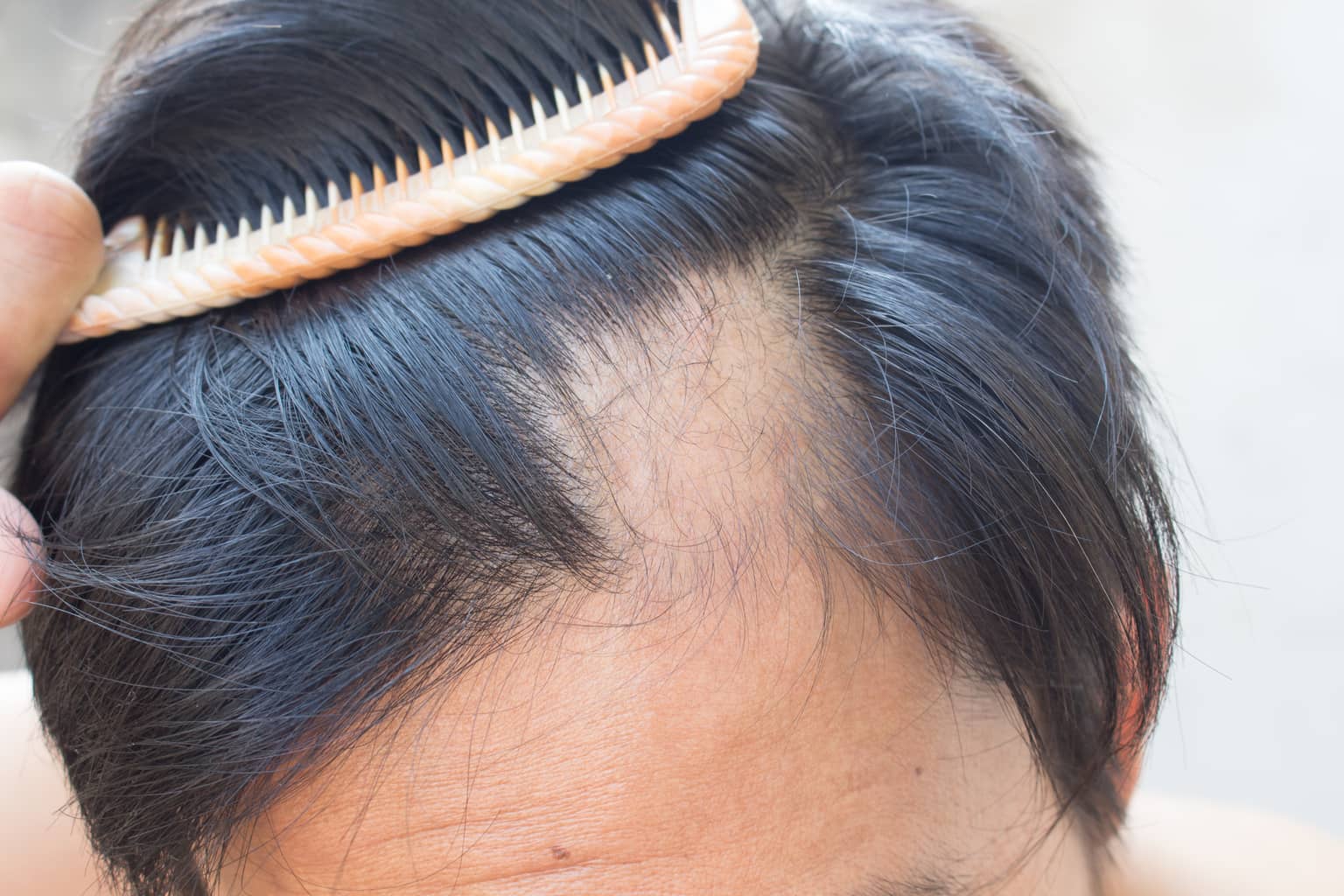 Insights On Hair Loss: Is DHT a Red Herring?