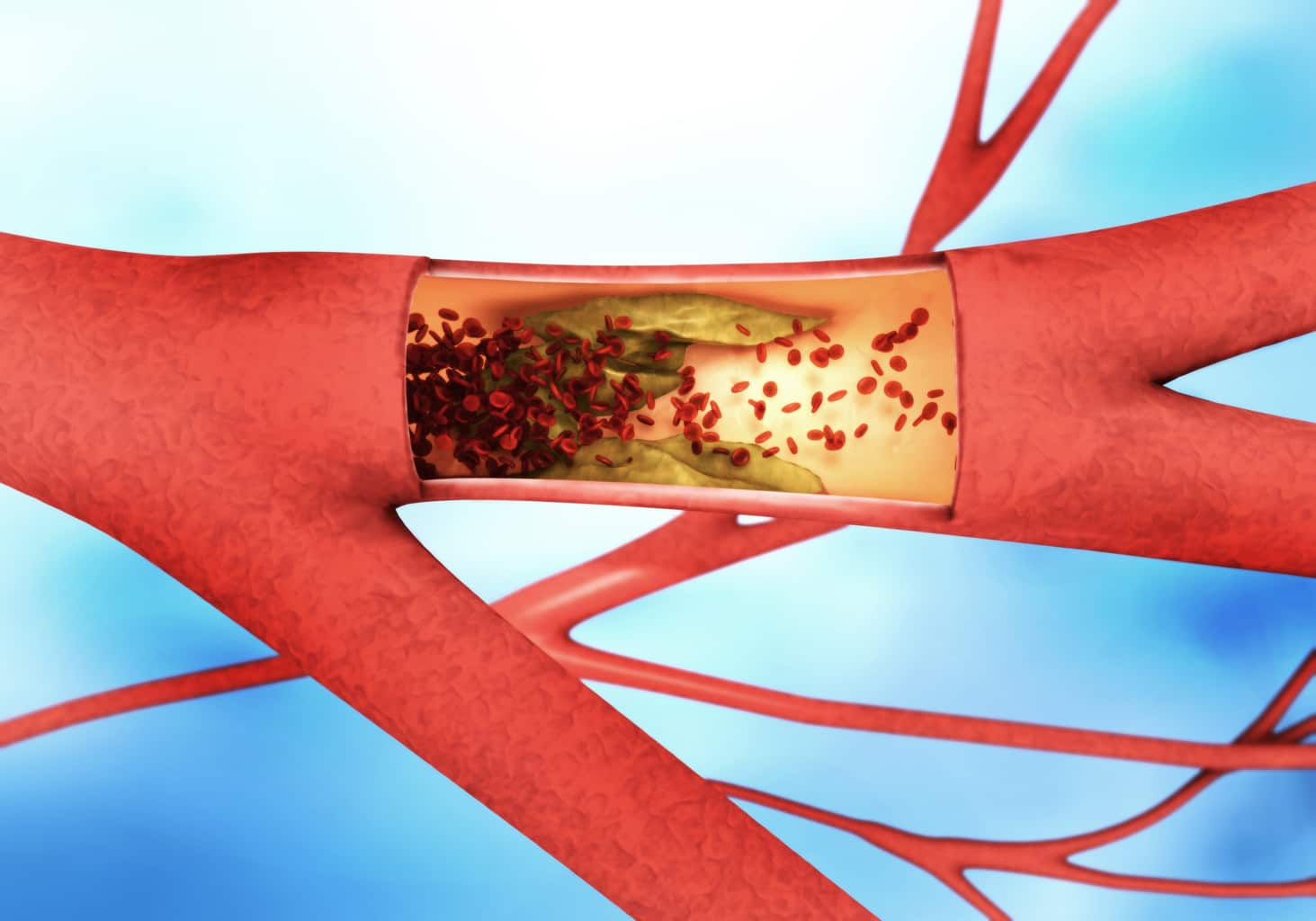 The link between hardening of the arteries and erectile dysfunction