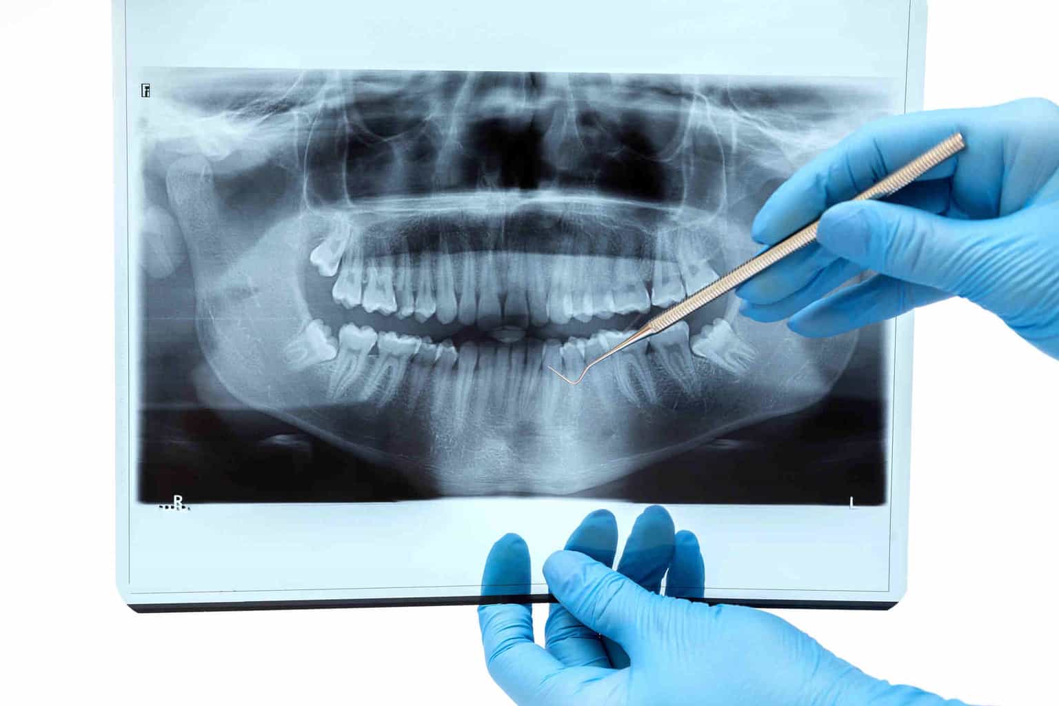 Does radiation from dental X-rays cause thyroid cancer?