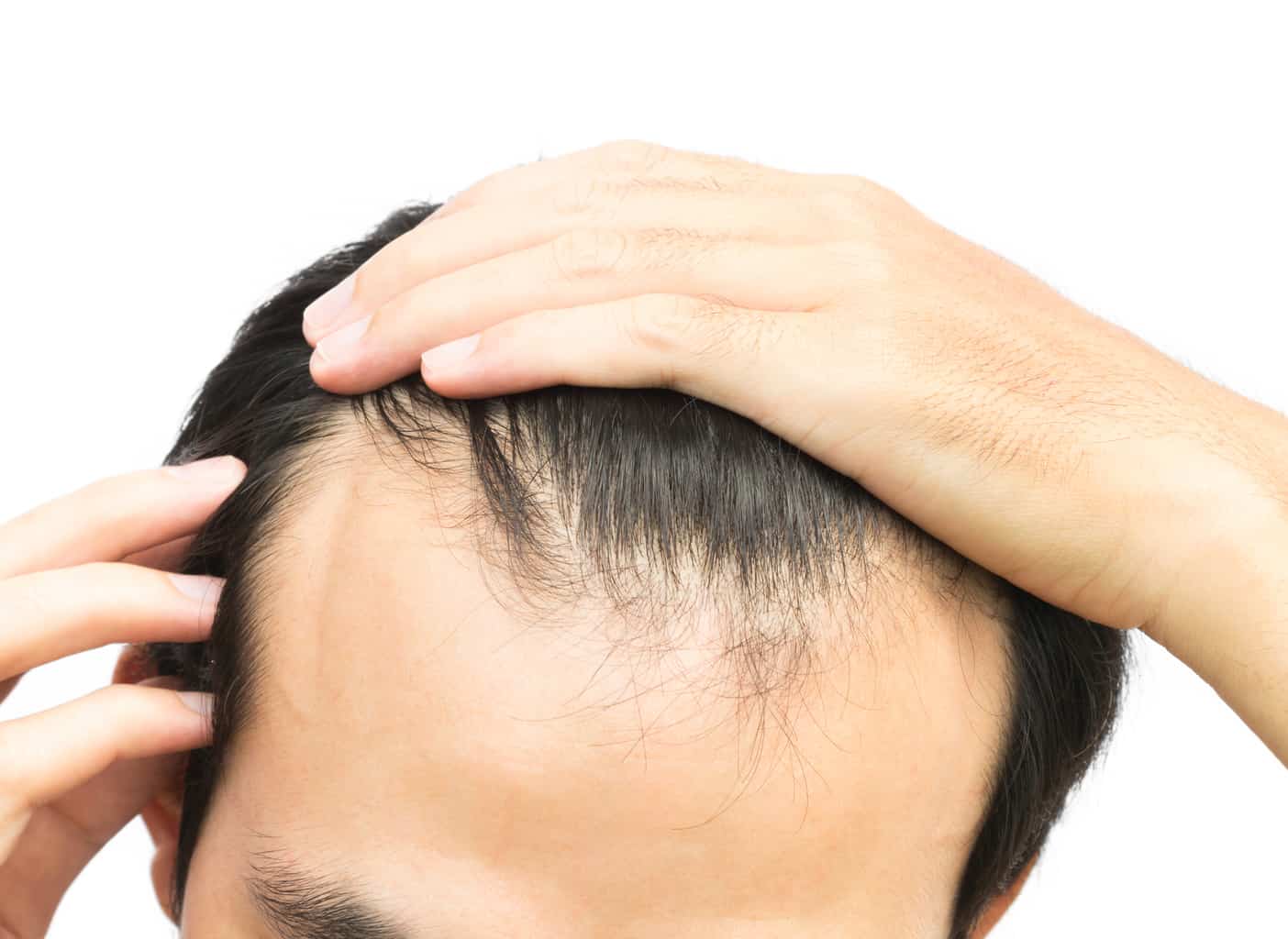 Can hair loss be an allergic reaction to this food?