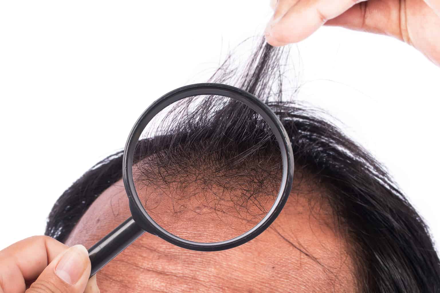 UCLA discovery: real hair regrowth for men