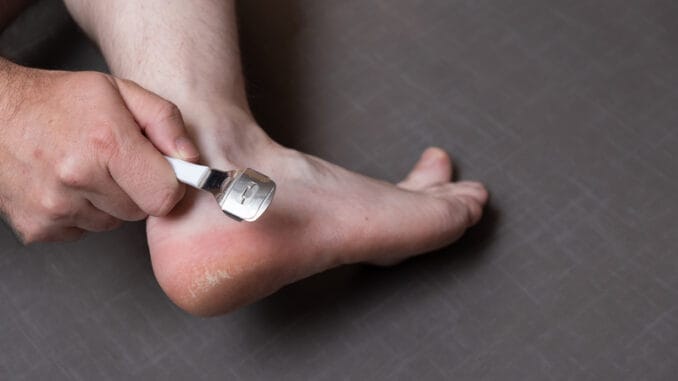 Man removing corn, callus from his feet using a razor file, masculine skin care, skin disease, fungal infection, skin treatment and healthcare, close up, caucasian, not recognizable