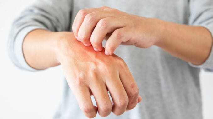 Young asian man itching and scratching on hand