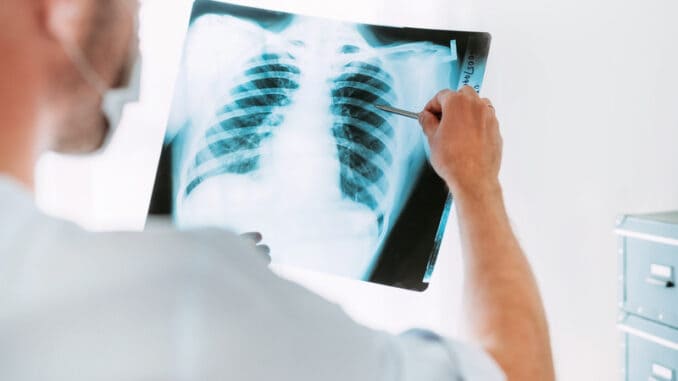 Male doctor examining the patient chest x-ray film lungs scan