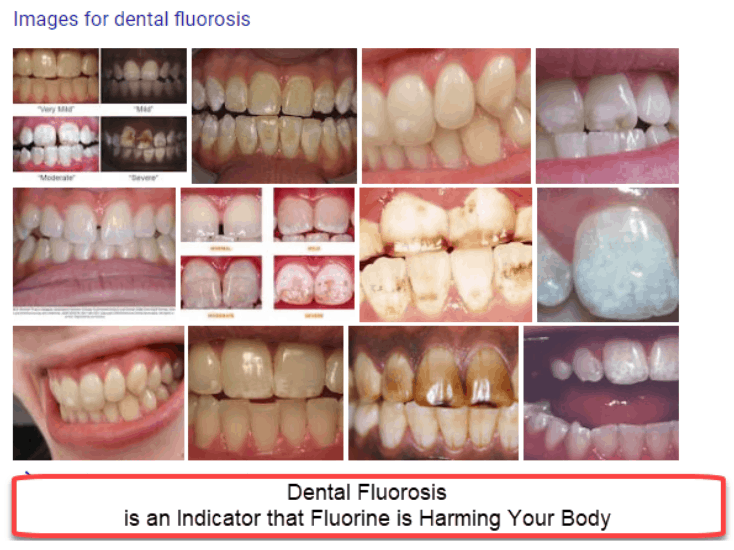 Images for dental fluorosis