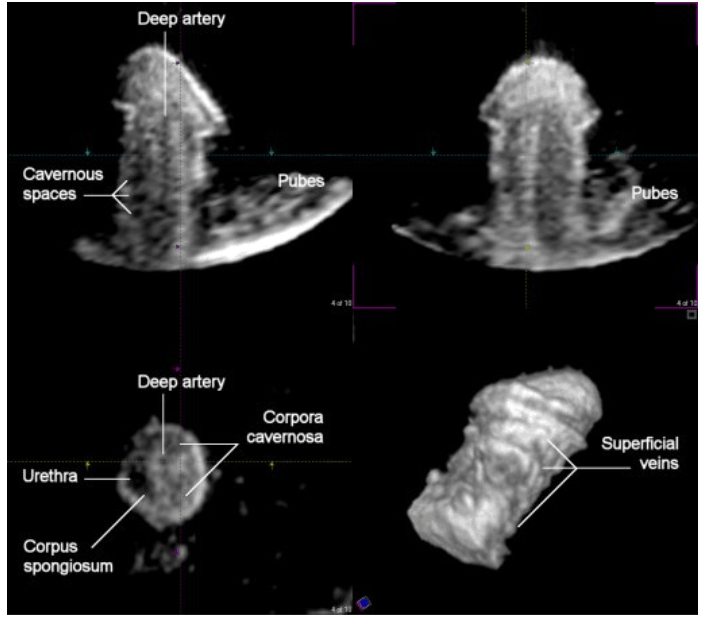 Penile Blood flow