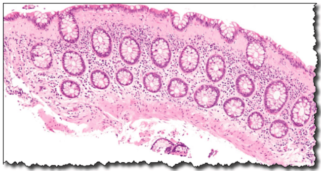 Daily Medical Discoveries Image - Leaky Gut