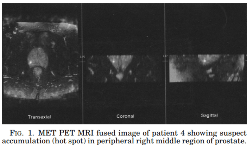 Figure1. <ET PET MRI fused image of patient 4 showing suspect accumulation (hot spot) in peripheral right middle region of prostate