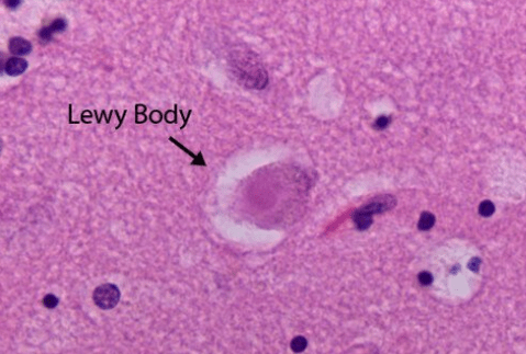 Lewy bodies in the brain
